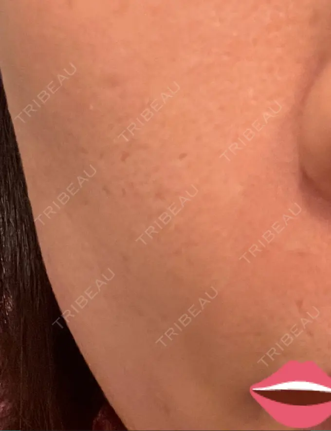 脂肪注入（肌） 湘南美容クリニック 秋葉原院 DAY 10 メイン用