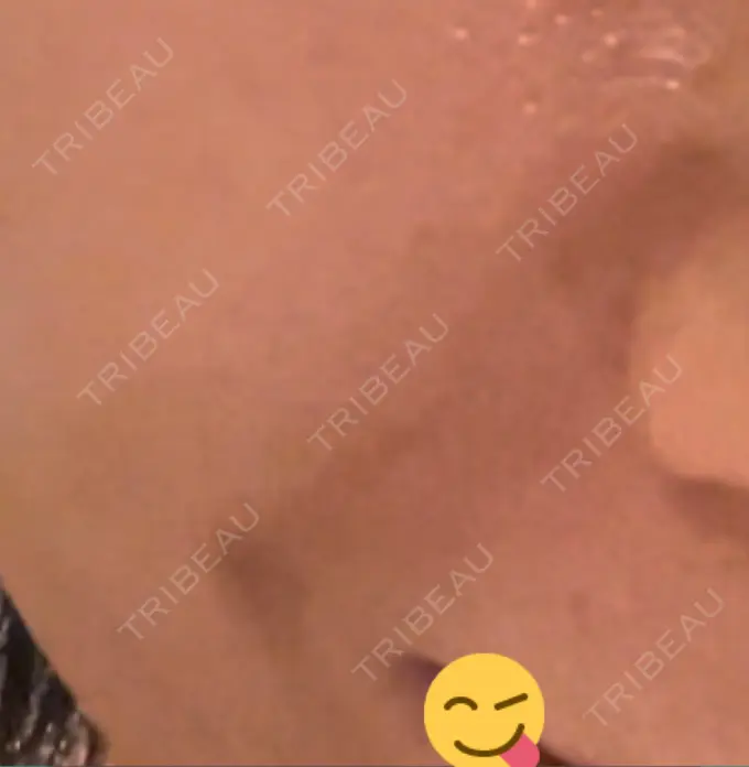 脂肪注入（肌） 湘南美容クリニック 秋葉原院 DAY 11 メイン用