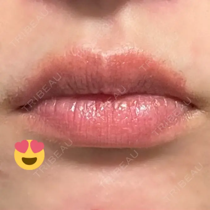 口角挙上 宇都宮竹内クリニック DAY 31 メイン用