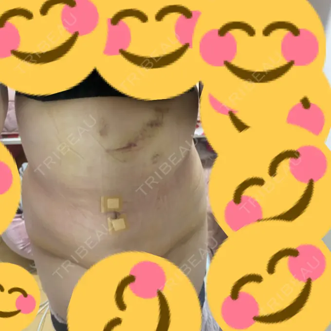 脂肪吸引（お腹） ガーデンクリニック 名古屋院 DAY 6 メイン用