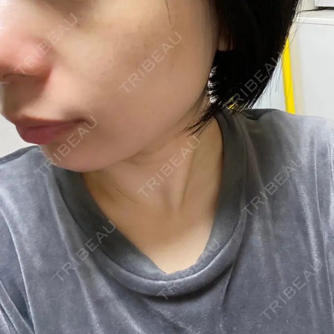 ピコレーザートーニング（美白・肝斑） ルラ美容クリニック 名古屋本院 DAY 4 メイン用