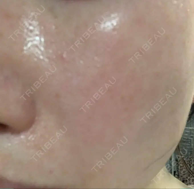 ピコレーザートーニング（美白・肝斑） 栄美容クリニック 栄院 DAY 16 メイン用