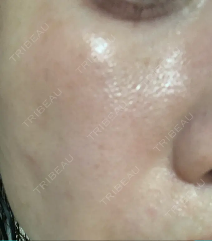 ピコレーザートーニング（美白・肝斑） 栄美容クリニック 栄院 DAY 16 メイン用