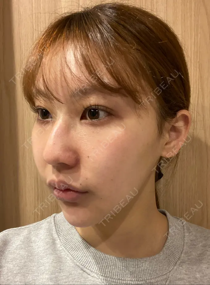 糸リフト / バッカルファット除去 / 脂肪吸引（顔） / ボトックス（あご） / ヒアルロン酸注入（あご） / ボトックス（エラ・小顔） WOM CLINIC GINZA （ワム クリニック ギンザ） DAY 505 メイン用