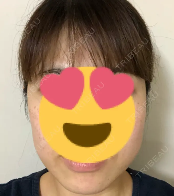 ボトックス（エラ・小顔） 湘南美容クリニック 名古屋栄院 AFTER メイン用