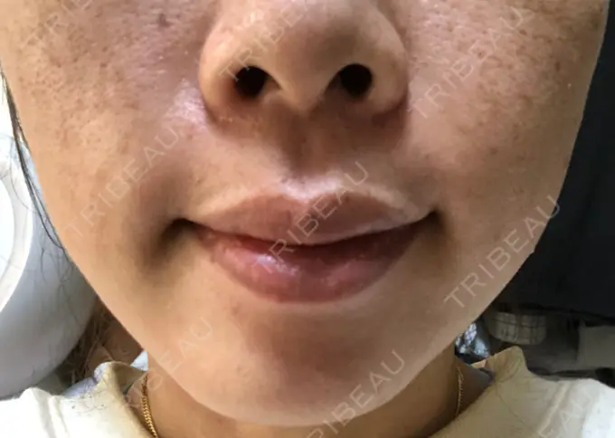 ボトックス（あご） / ボトックス（エラ・小顔） / ボトックス（目尻） TCB東京中央美容外科 新宿三丁目院 DAY 0 メイン用