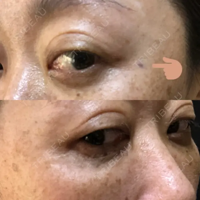 ボトックス（あご） / ボトックス（エラ・小顔） / ボトックス（目尻） TCB東京中央美容外科 新宿三丁目院 DAY 0 メイン用