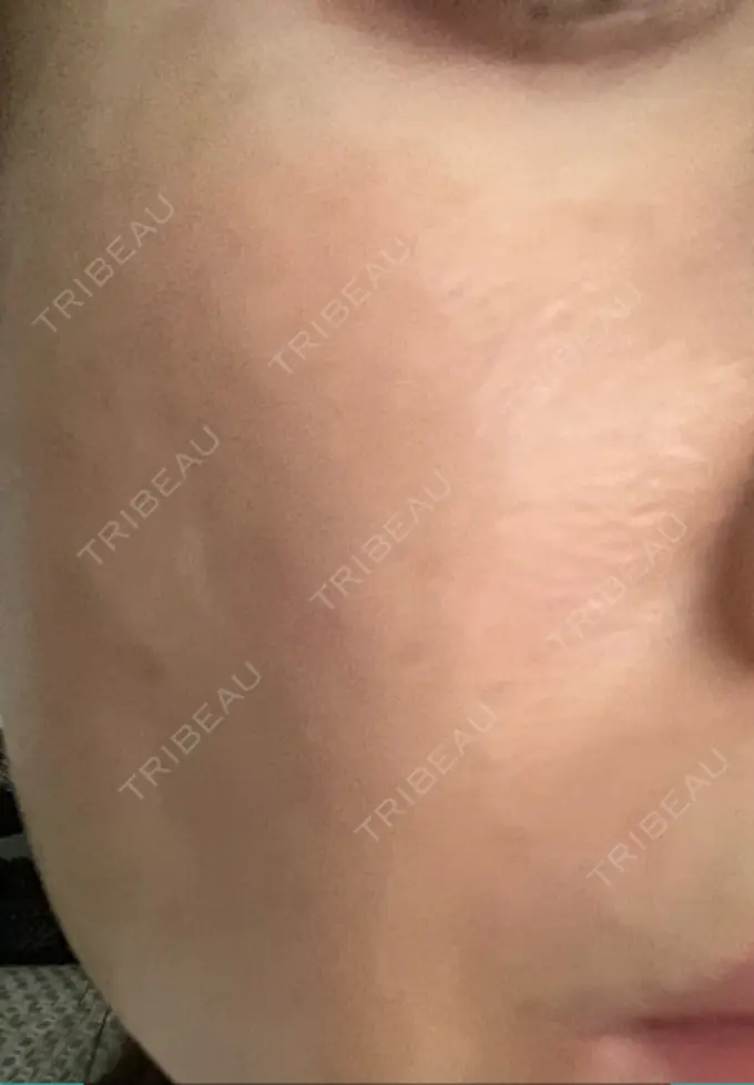 ピコレーザートーニング（美白・肝斑） 栄美容クリニック 栄院 AFTER メイン用