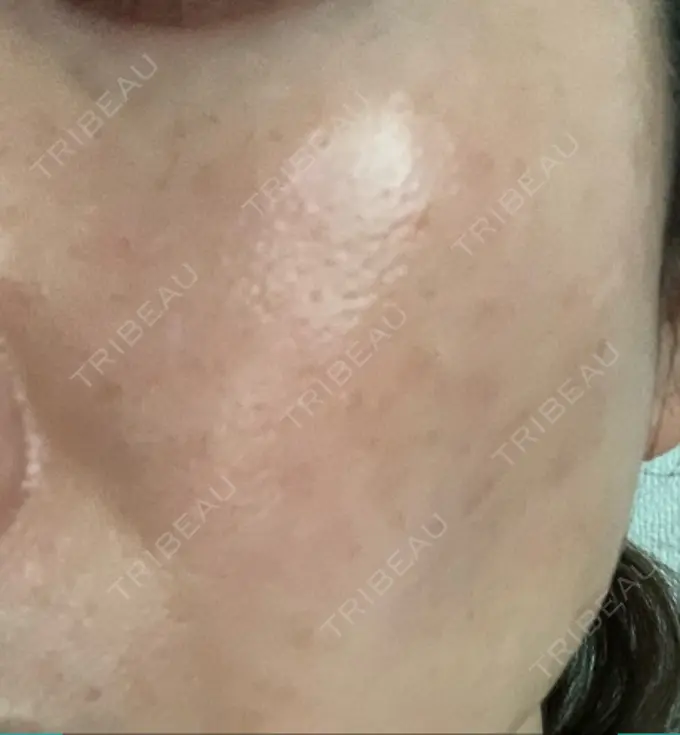 ピコレーザートーニング（美白・肝斑） 栄美容クリニック 栄院 DAY 17 メイン用