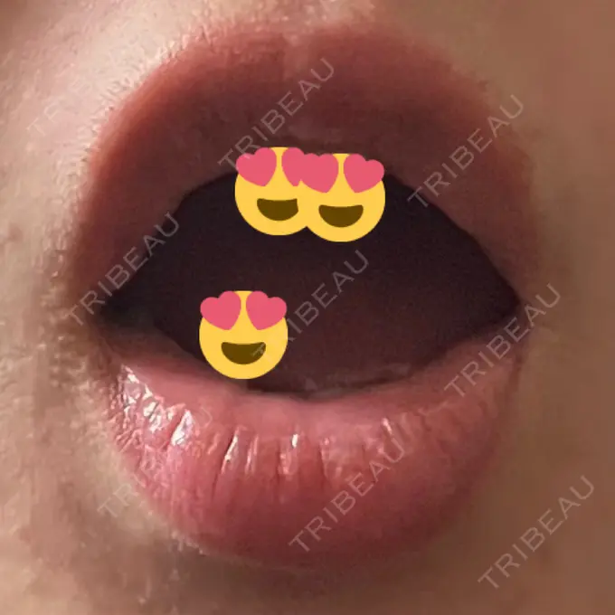 口角挙上 宇都宮竹内クリニック DAY 31 メイン用