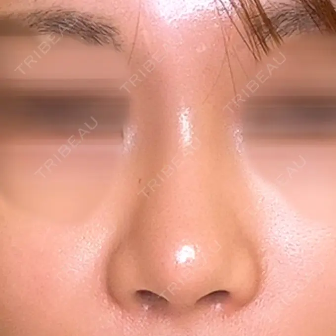 軟骨移植 / 骨切幅寄せ / 鼻中隔延長（非切開） エイト美容外科 AFTER メイン用