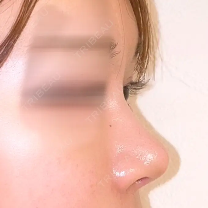 軟骨移植 / 骨切幅寄せ / 鼻中隔延長（非切開） エイト美容外科 DAY 182 メイン用