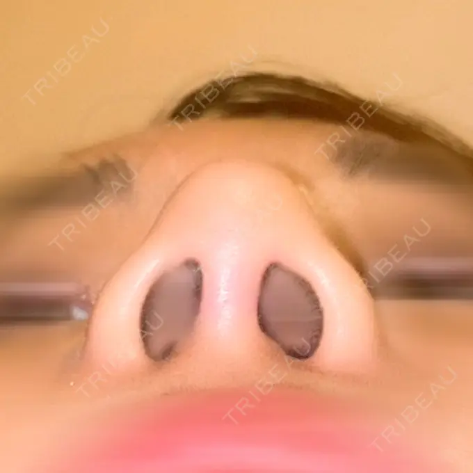 軟骨移植 / 骨切幅寄せ / 鼻中隔延長（非切開） エイト美容外科 DAY 182 メイン用