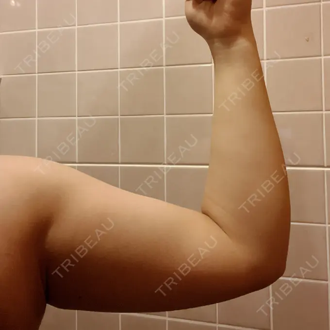 脂肪冷却（二の腕） KOSHOクリニック 本館 DAY 66 メイン用