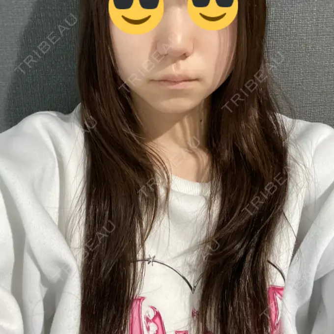 鼻尖形成（切開） / 小鼻縮小（切開） / 軟骨移植 / 鼻孔縁挙上 東京美容医療クリニック 池袋院 DAY 16 メイン用