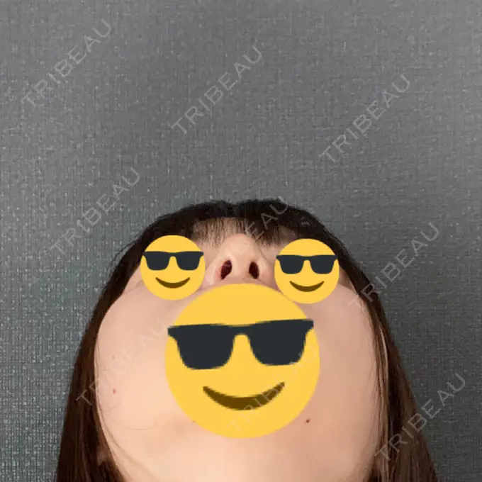 鼻尖形成（切開） / 小鼻縮小（切開） / 軟骨移植 / 鼻孔縁挙上 東京美容医療クリニック 池袋院 DAY 16 メイン用