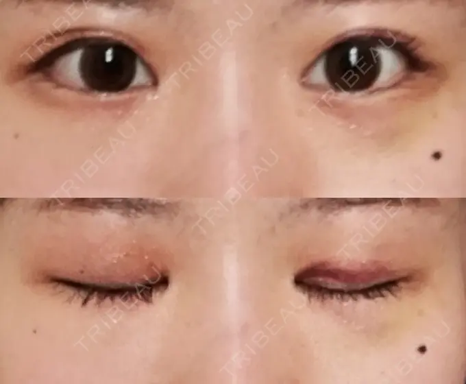 目頭切開 / 目尻切開 / 水光注射（ハリ・美肌） エートップ美容整形外科 DAY 12 メイン用