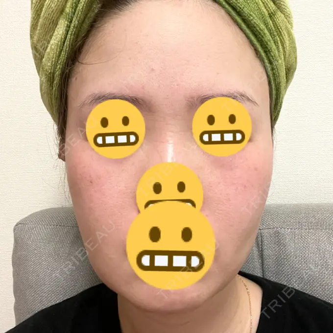 糸リフト / 脂肪吸引（顔） / 脂肪注入（目の下） WOM CLINIC GINZA （ワム クリニック ギンザ） DAY 25 メイン用