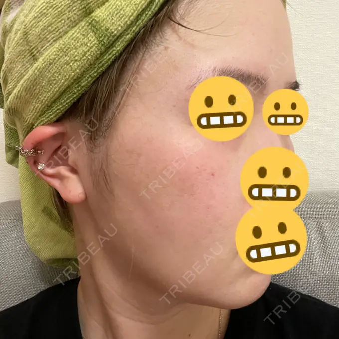 糸リフト / 脂肪吸引（顔） / 脂肪注入（目の下） WOM CLINIC GINZA （ワム クリニック ギンザ） DAY 25 メイン用