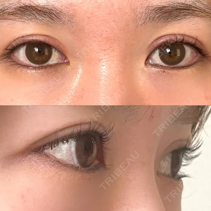 二重切開 / 上まぶたたるみ取り みずほクリニック DAY 105 メイン用