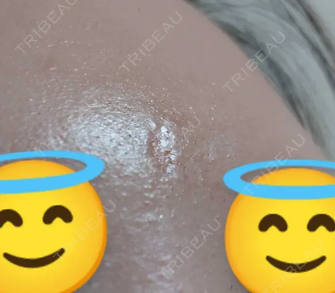 傷跡修正 / 傷跡修正 TETSU形成・美容クリニック DAY 48 メイン用