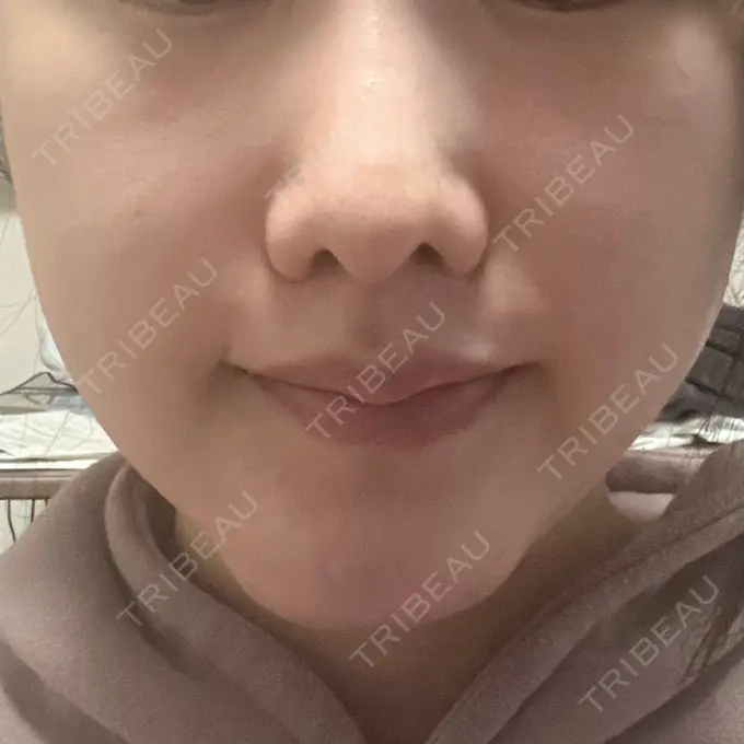 脂肪溶解注射（顔） 東京たかはしクリニック 練馬院 DAY 6 メイン用