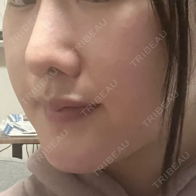 脂肪溶解注射（顔） 東京たかはしクリニック 練馬院 DAY 6 メイン用