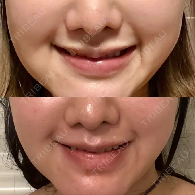 脂肪溶解注射（顔） 東京たかはしクリニック 練馬院 DAY 8 メイン用