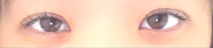 二重埋没 / 目頭切開 くさのたろうクリニック DAY 90 メイン用