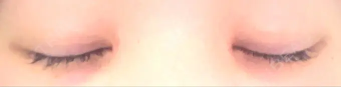 二重埋没 / 目頭切開 くさのたろうクリニック DAY 90 メイン用