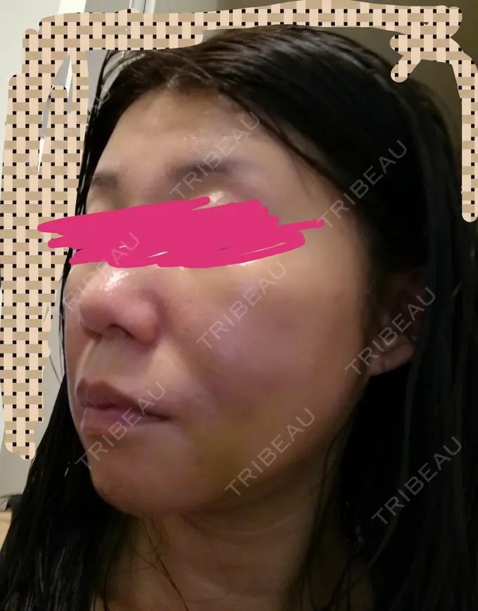 糸リフト 有楽町高野美容クリニック DAY 47 メイン用