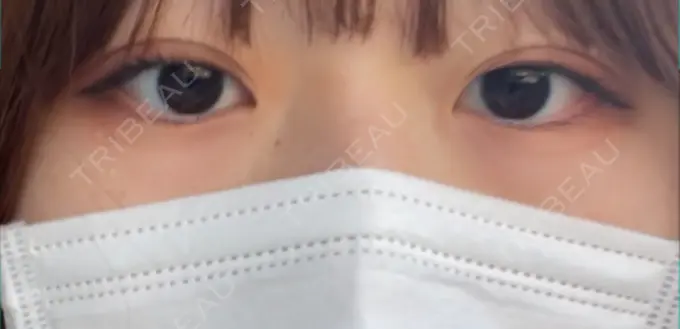 二重埋没 水の森美容クリニック 東京銀座院 DAY 10 メイン用