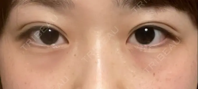 二重埋没 水の森美容クリニック 東京銀座院 AFTER メイン用