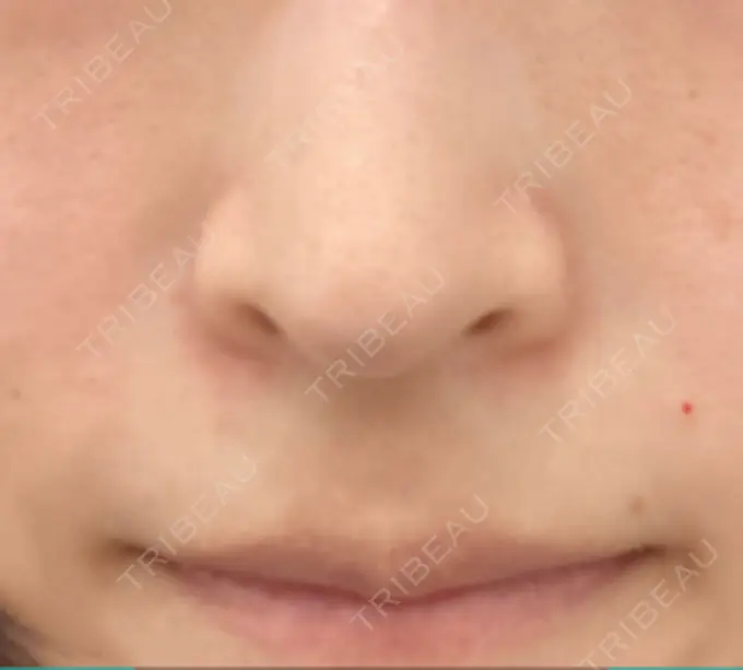 その他（鼻） ルラ美容クリニック 名古屋本院 DAY 0 メイン用