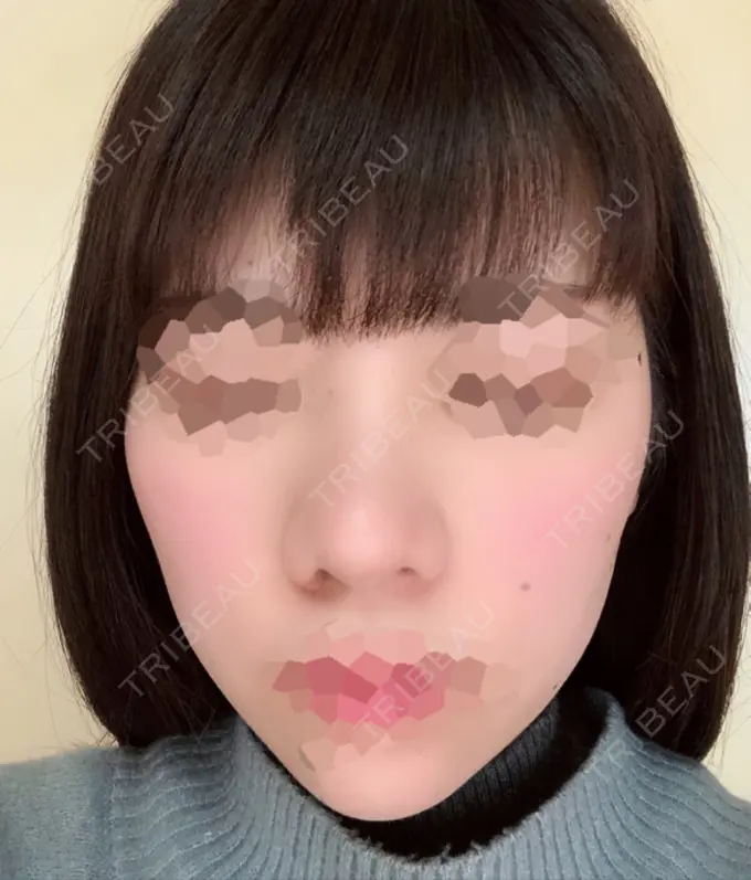 隆鼻術 / 鼻尖形成（切開） / 小鼻縮小（切開） 湘南美容クリニック 岡山院 DAY 48 メイン用