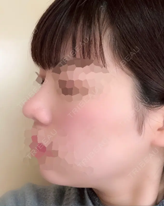 隆鼻術 / 鼻尖形成（切開） / 小鼻縮小（切開） 湘南美容クリニック 岡山院 DAY 48 メイン用
