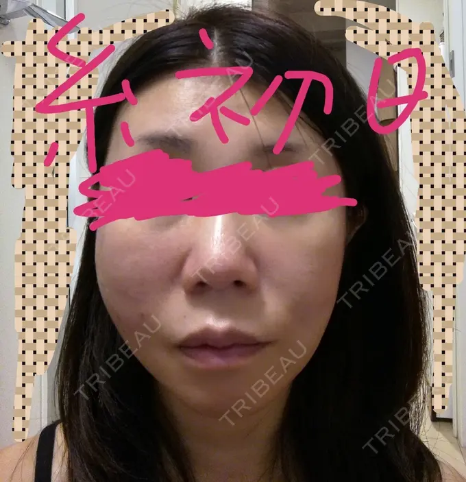 糸リフト 有楽町高野美容クリニック DAY 71 メイン用