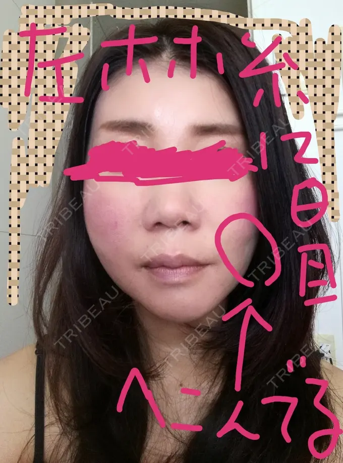 糸リフト 有楽町高野美容クリニック DAY 82 メイン用