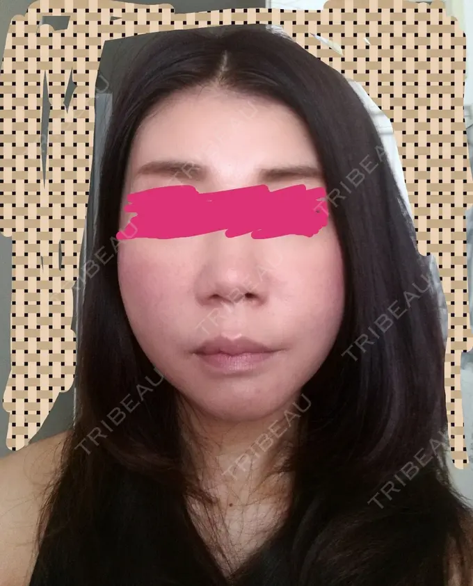 糸リフト 有楽町高野美容クリニック DAY 166 メイン用