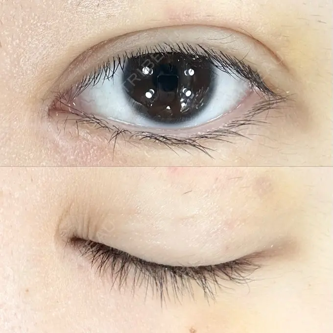 二重埋没 AI Beauty Clinic （エーアイ美容クリニック） DAY 16 メイン用