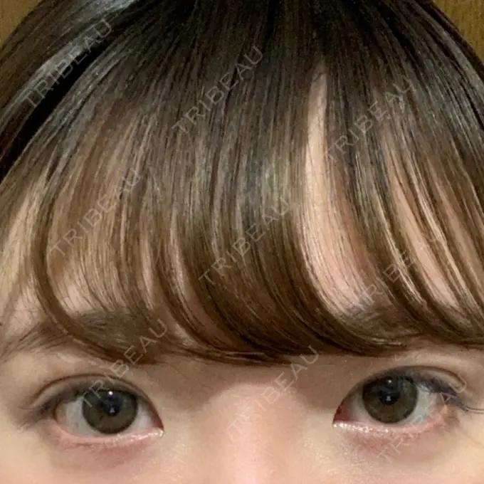 二重埋没 グランメドクリニック茨木 DAY 7 メイン用