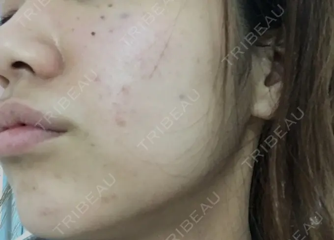 ほくろ・いぼ切除（肌） / 白玉点滴・注射 / プラセンタ注射 / その他（肌） / 美肌レーザー / ほくろ・いぼ除去レーザー（肌） / ニキビ治療 YOU&I皮膚科 明洞店 DAY 0 メイン用