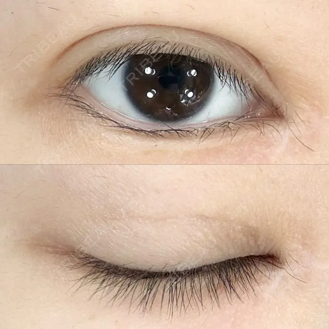 二重埋没 AI Beauty Clinic （エーアイ美容クリニック） DAY 17 メイン用