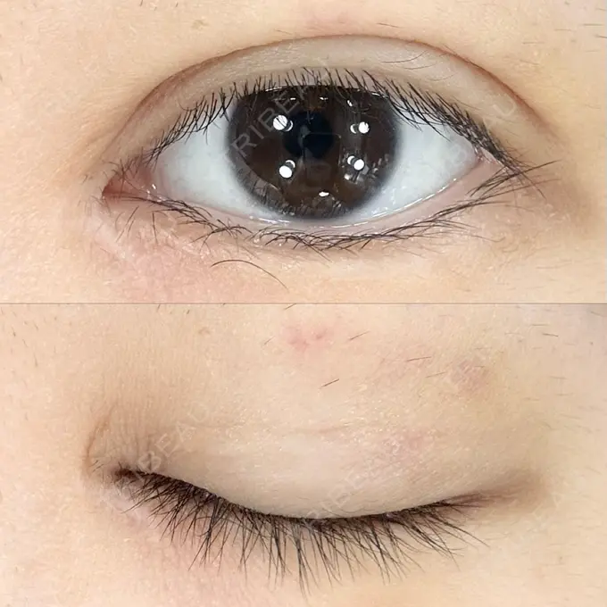 二重埋没 AI Beauty Clinic （エーアイ美容クリニック） DAY 17 メイン用