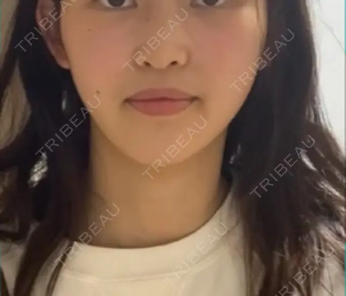 糸リフト / 脂肪吸引（顔） / ボトックス（エラ・小顔） HAAB×DREAM BEAUTY CLINIC 東京本院 AFTER メイン用