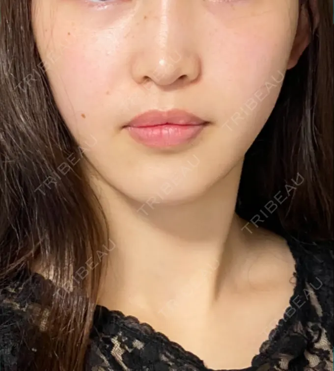 糸リフト / 脂肪吸引（顔） / ボトックス（エラ・小顔） HAAB×DREAM BEAUTY CLINIC 東京本院 DAY 226 メイン用