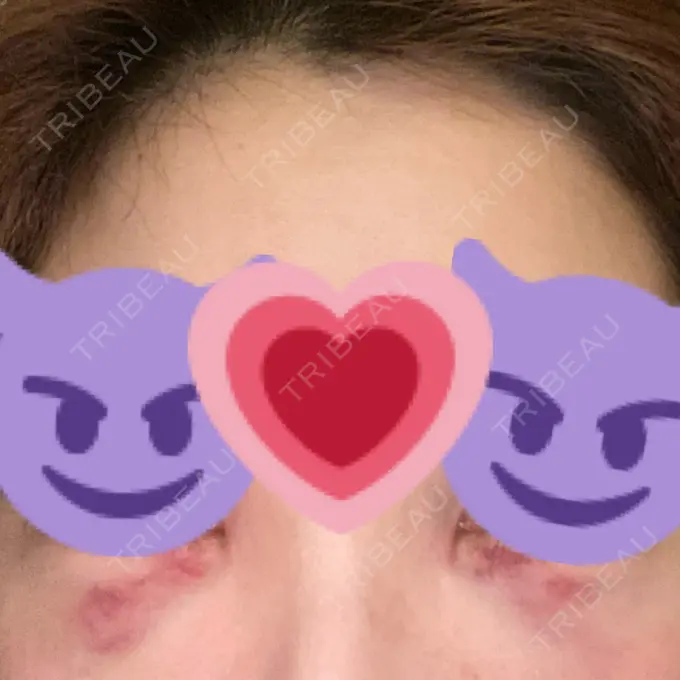 下まぶたたるみ取り 吉井クリニック AFTER メイン用