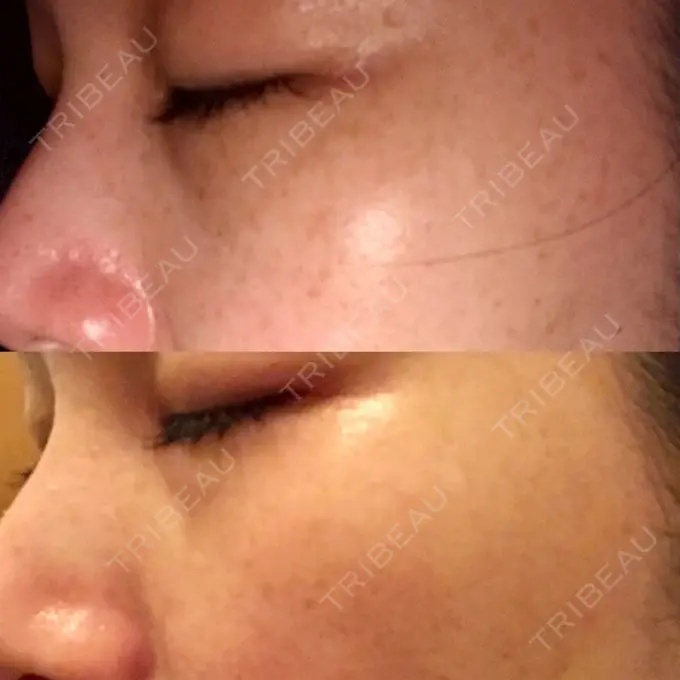 シミ取りレーザー 仁愛クリニック DAY 14 メイン用