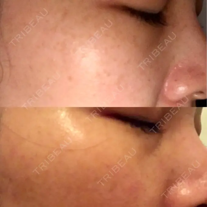 シミ取りレーザー 仁愛クリニック DAY 14 メイン用