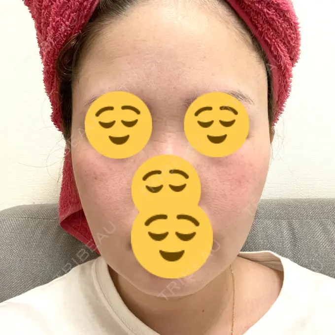 糸リフト / 脂肪吸引（顔） / 脂肪注入（目の下） WOM CLINIC GINZA （ワム クリニック ギンザ） DAY 35 メイン用